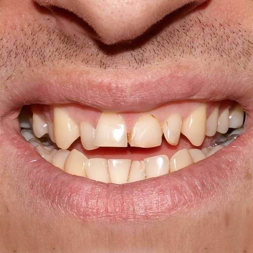Closeup of uneven teeth