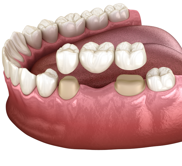 dental-bridges-san-diego-ca-tooth-bridge-balboa-dental-care