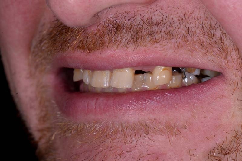 Before dental implant treatment