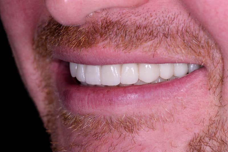 After dental implant treatment