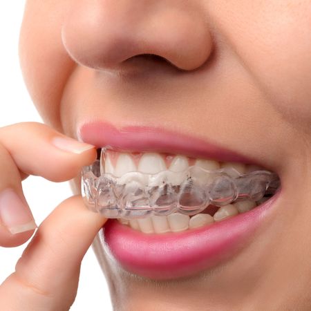 Women removing an Invisalign® aligner tray