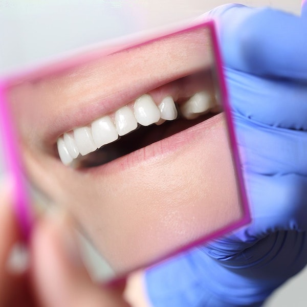 Missing tooth in mirror
