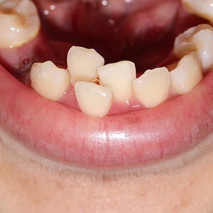 Crowded teeth