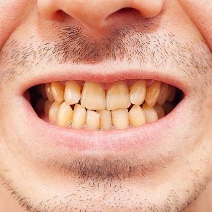 Yellowed teeth