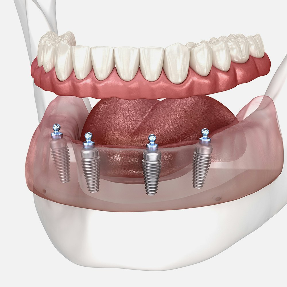 Implant denture