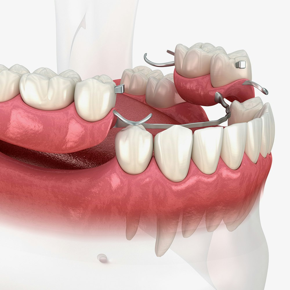 Removable Denture