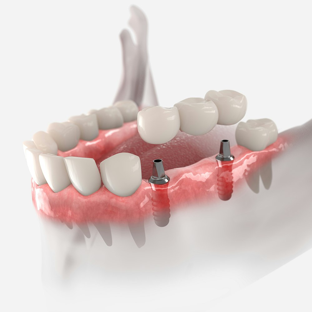 Implant bridge