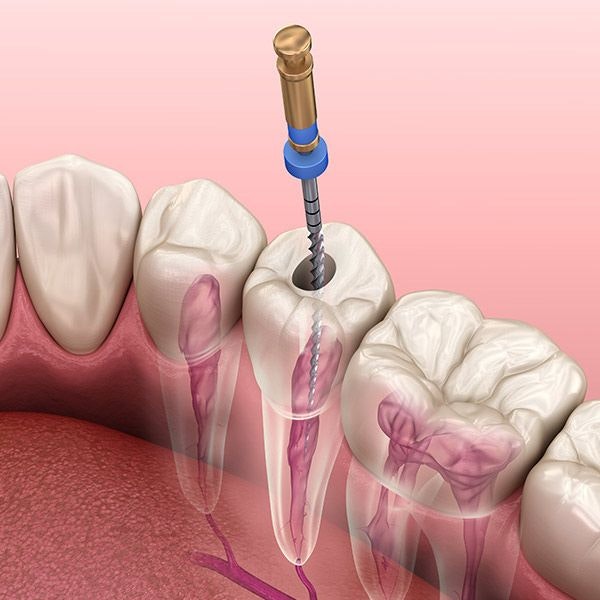 Root canal
