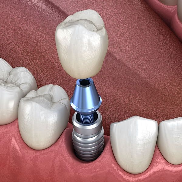 Implant crown