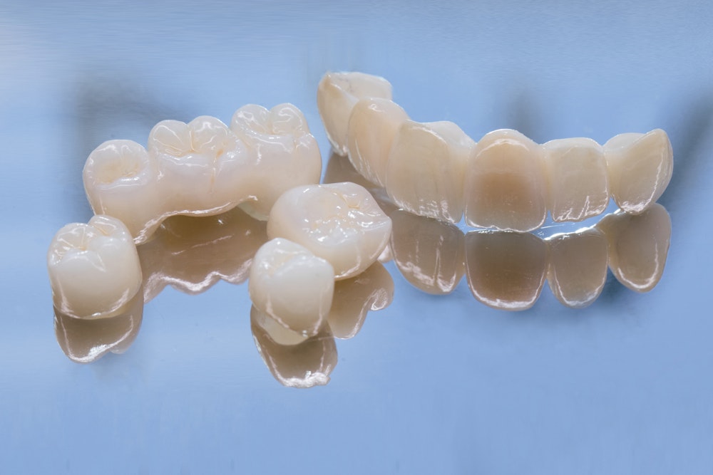 Dental bridges
