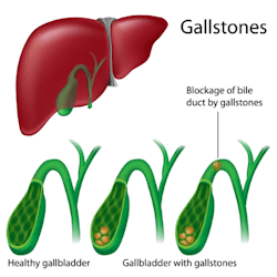 Gallstones diagram