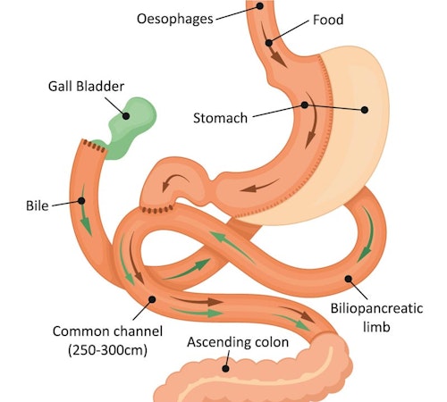 Diagram Single Anastomosis Duodenal Switch