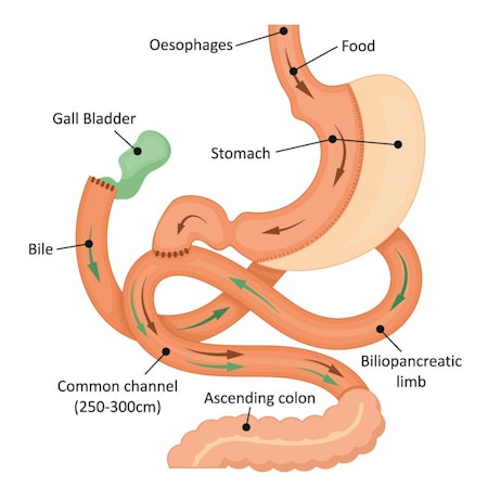 Diagram Single Anastomosis Duodenal Switch