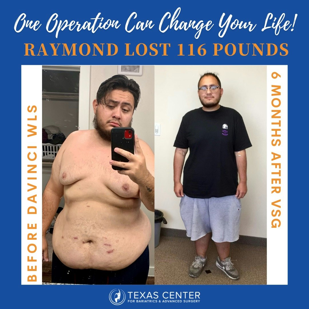 weight loss surgery transformation dr cribbins dallas tx