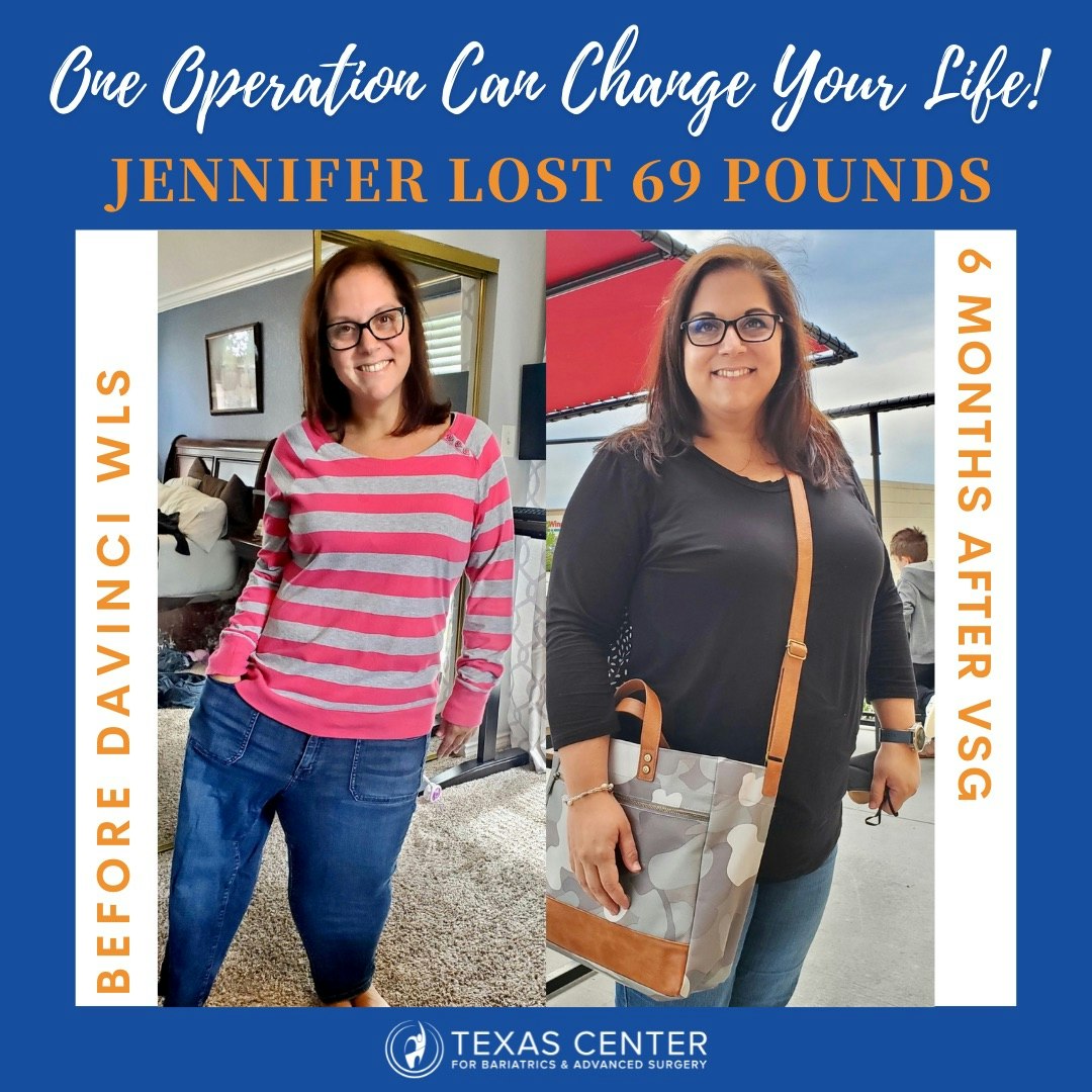 weight loss surgery transformation dr cribbins davinci robotic bariatric surgeon