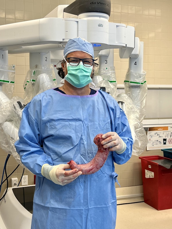 dr cribbins with removed eighty percent of stomach after vsg surgery
