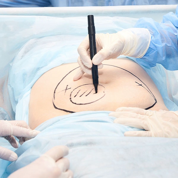 tummy tuck