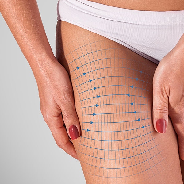 thigh lift