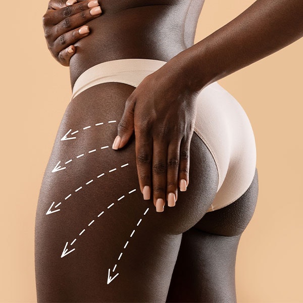 butt lift