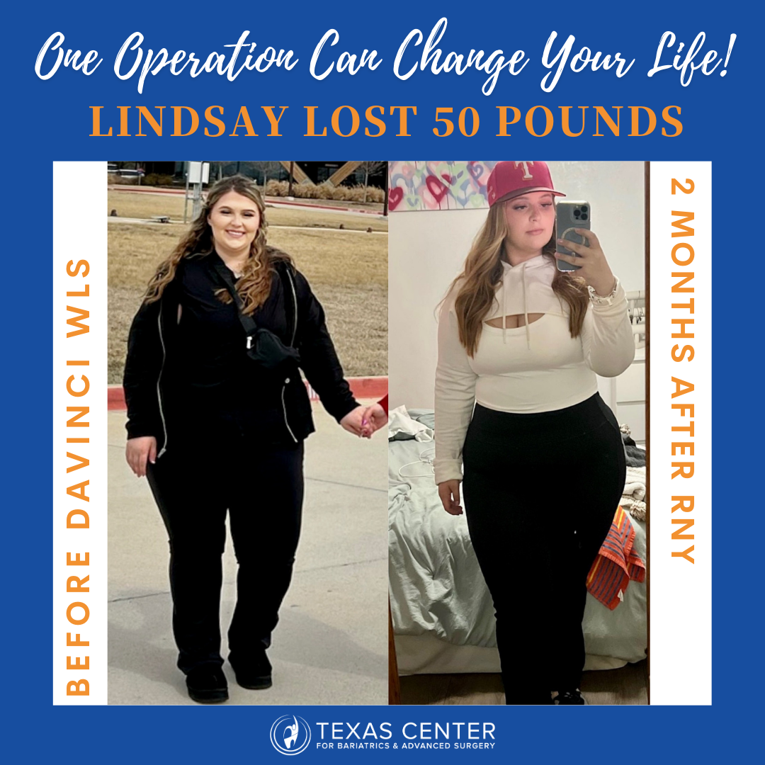 before and after gastric bypass surgery