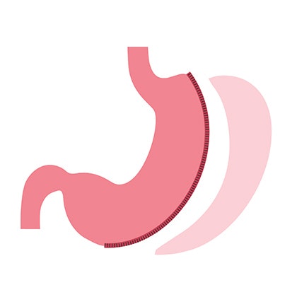 Gastric sleeve