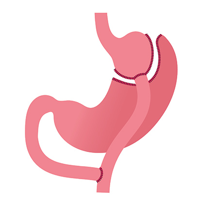 Gastric bypass