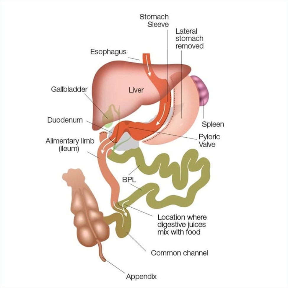illustration of a duodenal switch