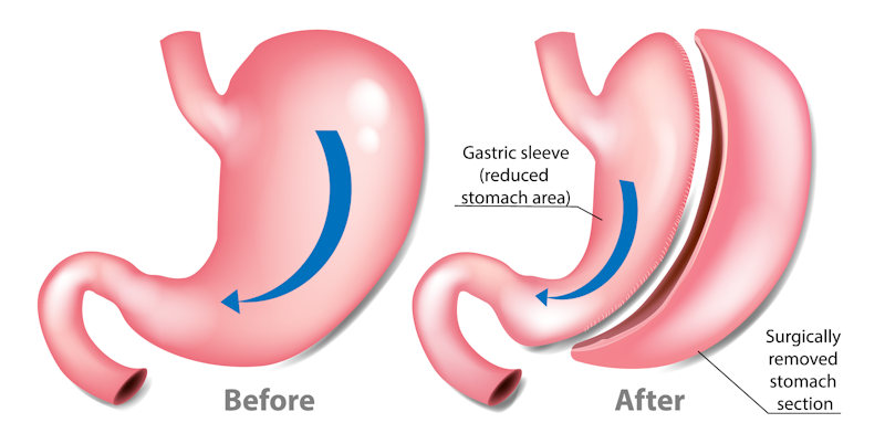 Illustration of before and after gastric sleeve