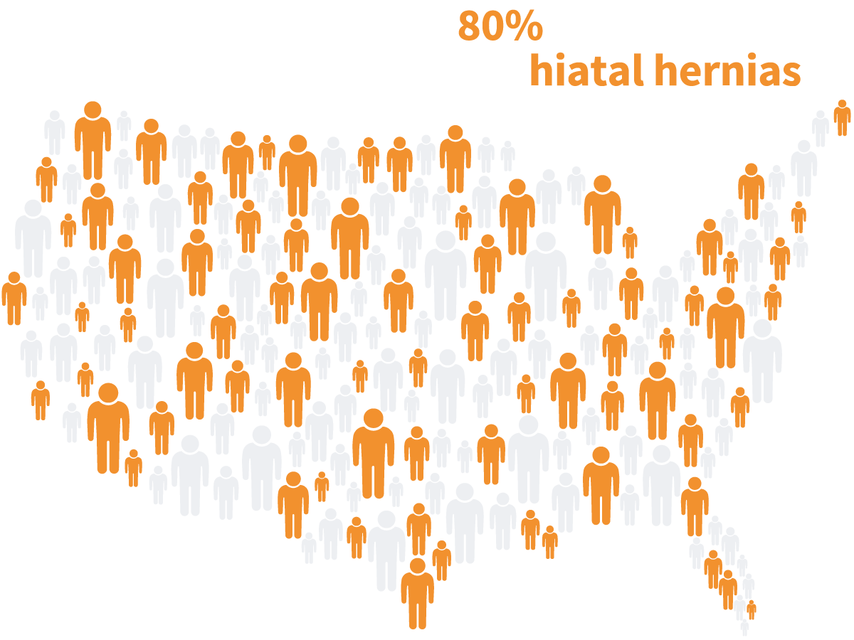 It's estimated that up to 80% of the American population is affected by hiatal hernias.