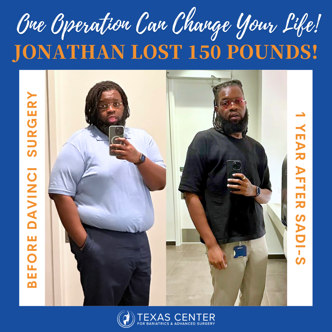 Jonathan 1 Year After SADI-s Surgery