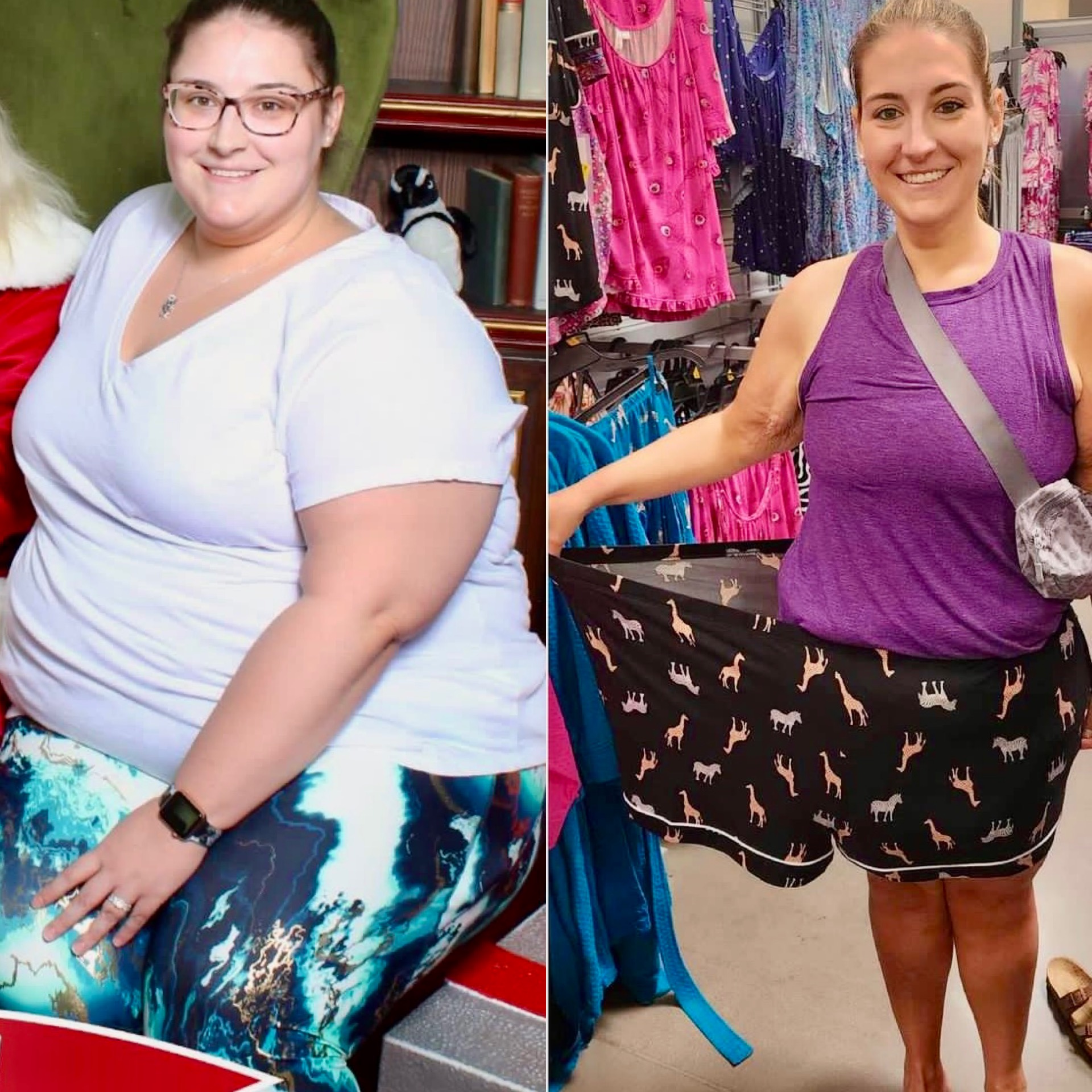 Katelyn Before and after surgery