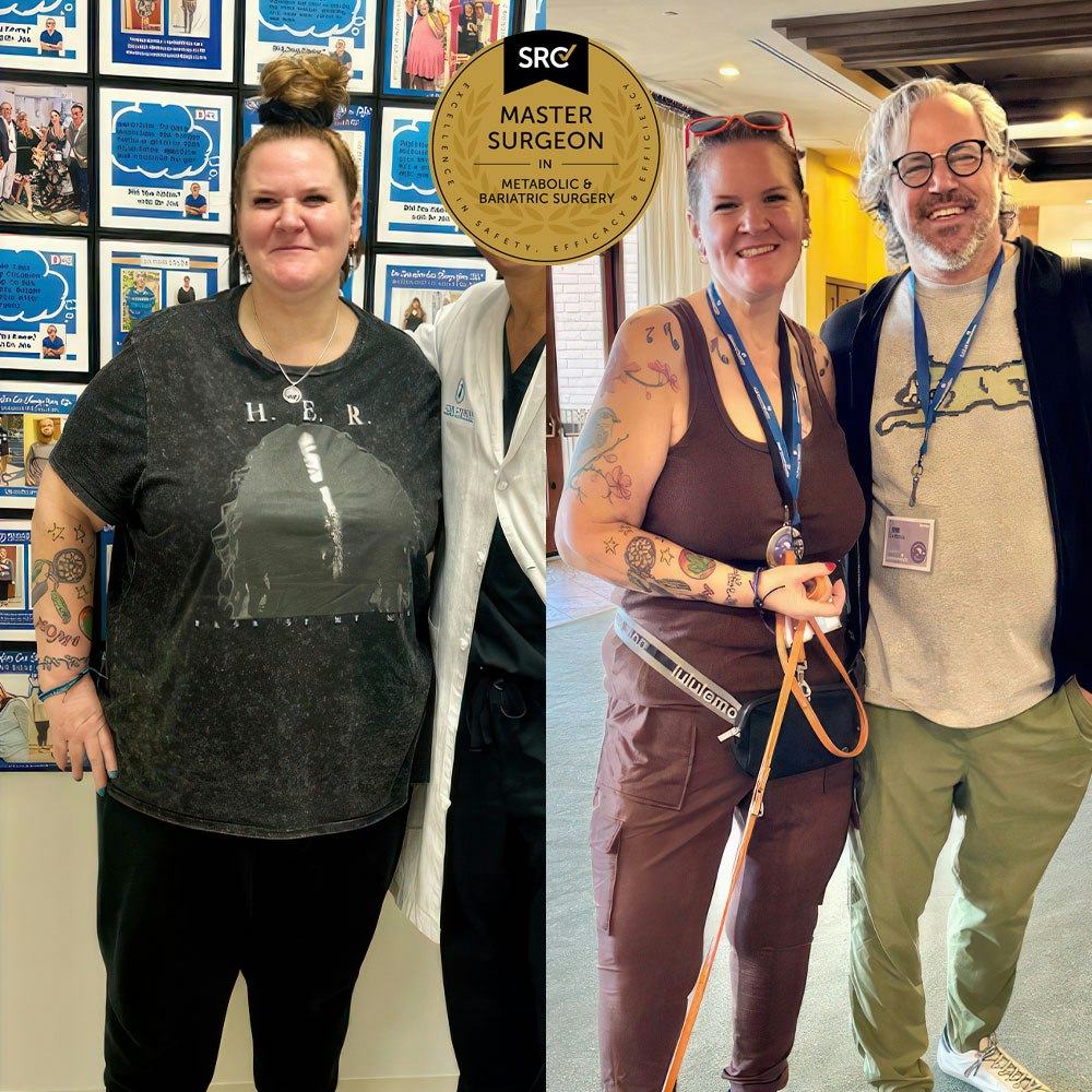 Smiling woman after SADI-S surgery