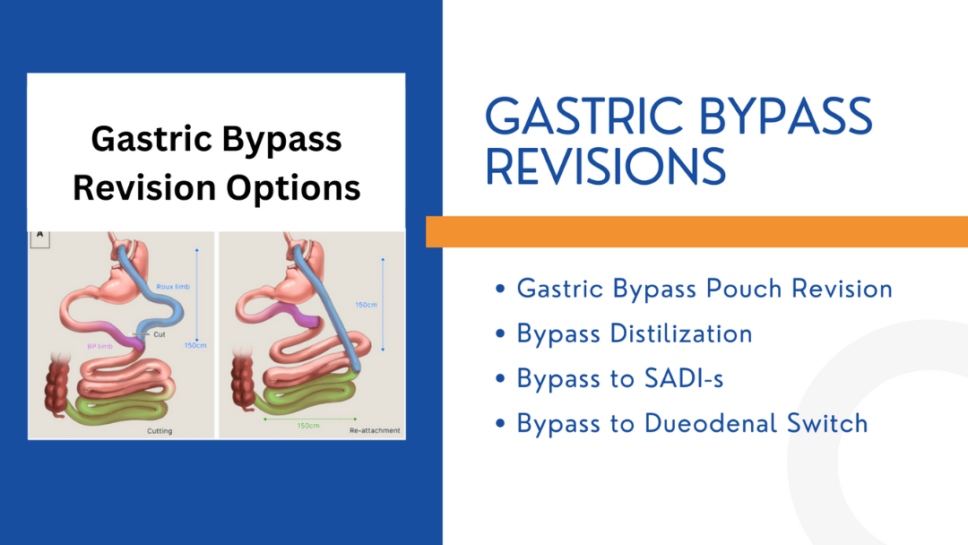 Bypass Distilization