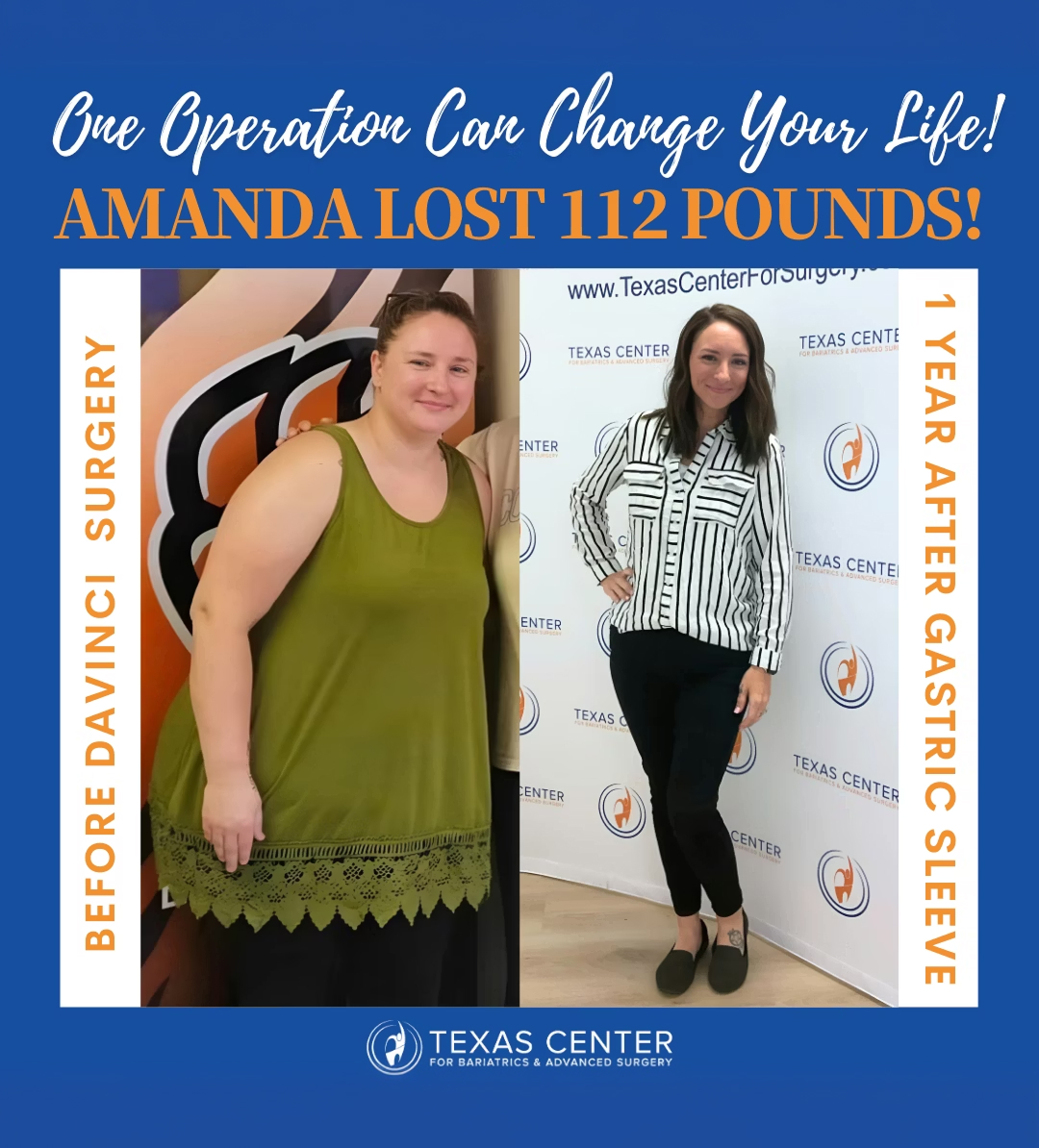 Amanda before and after gastric sleeve surgery