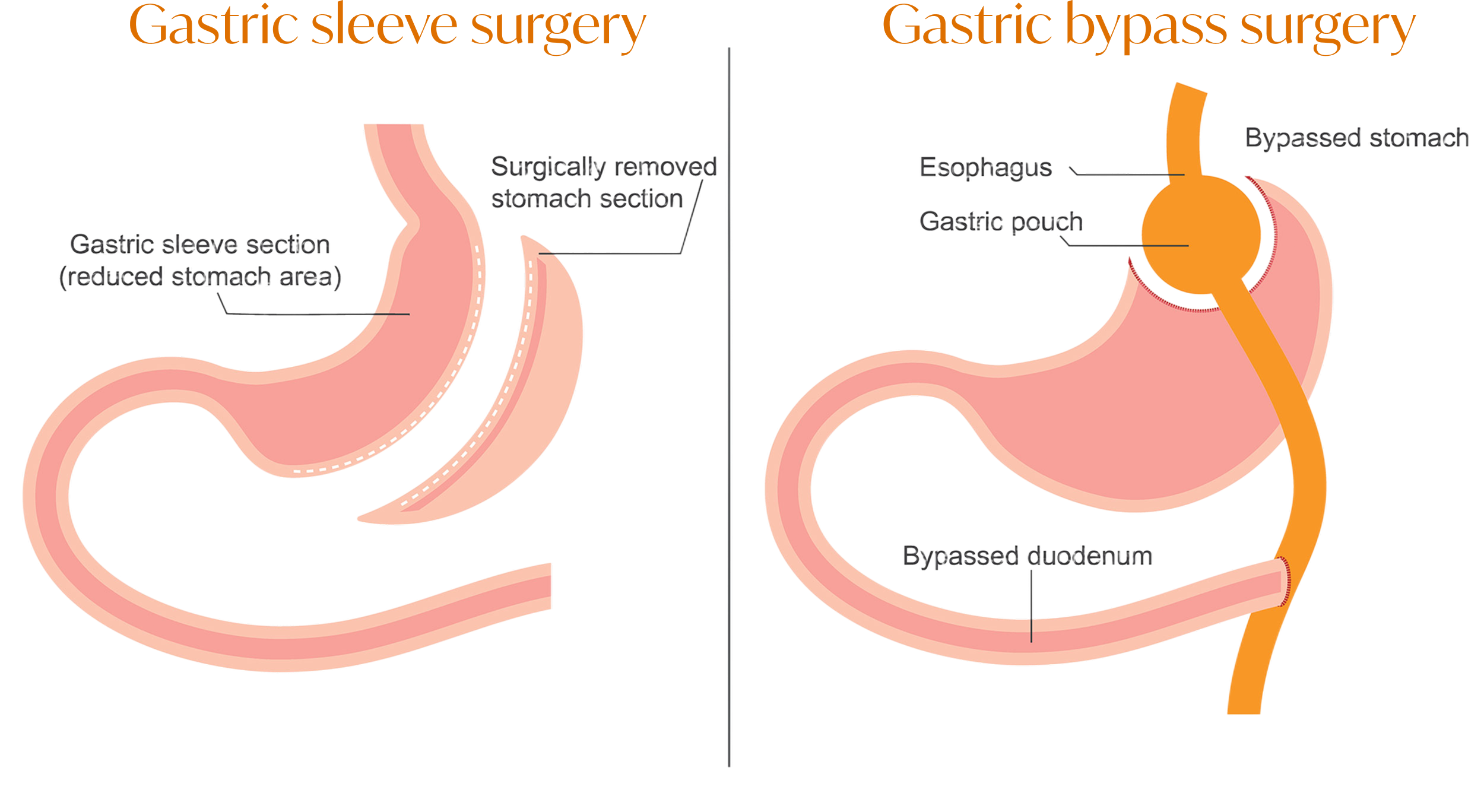 A diagram of gastric sleeve and gastric bypass surgery
