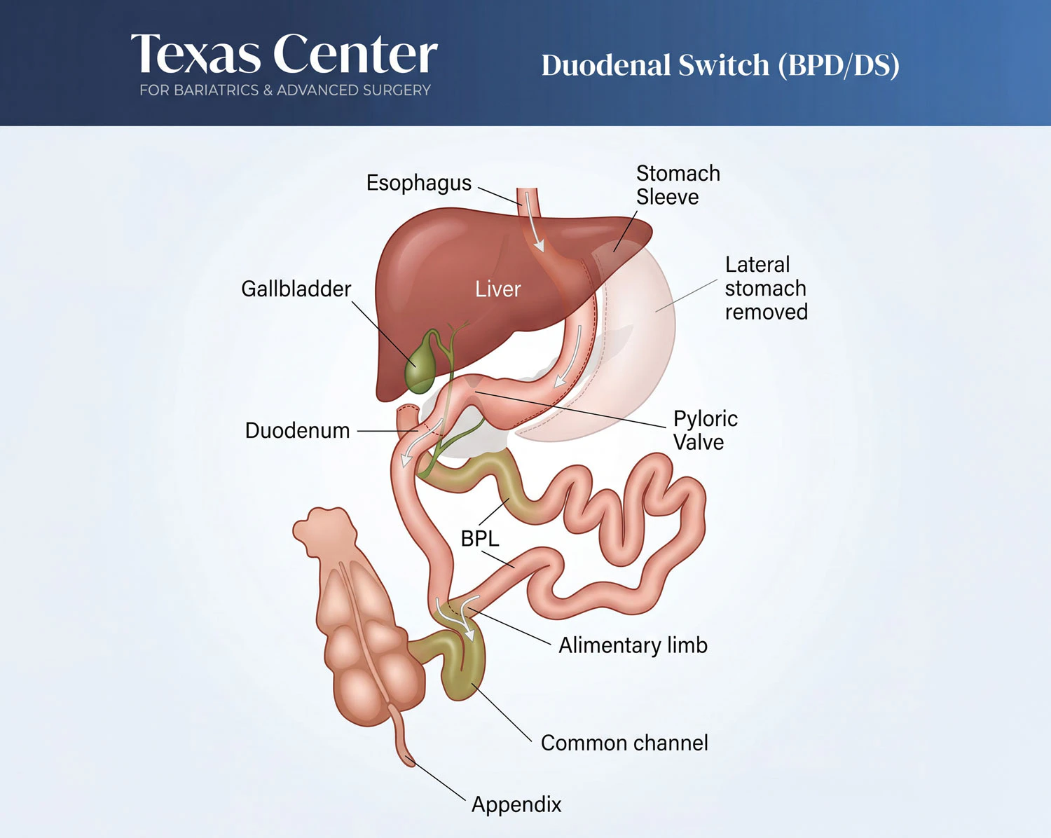 Duodenal Switch (BPD/DS) chart by Texas Center for Bariatrics & Advanced Surgery showcasing the esophagus, stomach sleeve, liver, gallbladder, lateral stomach removed, pyloric valve, BPL, duodenum, alimentary limb, common channel, appendix