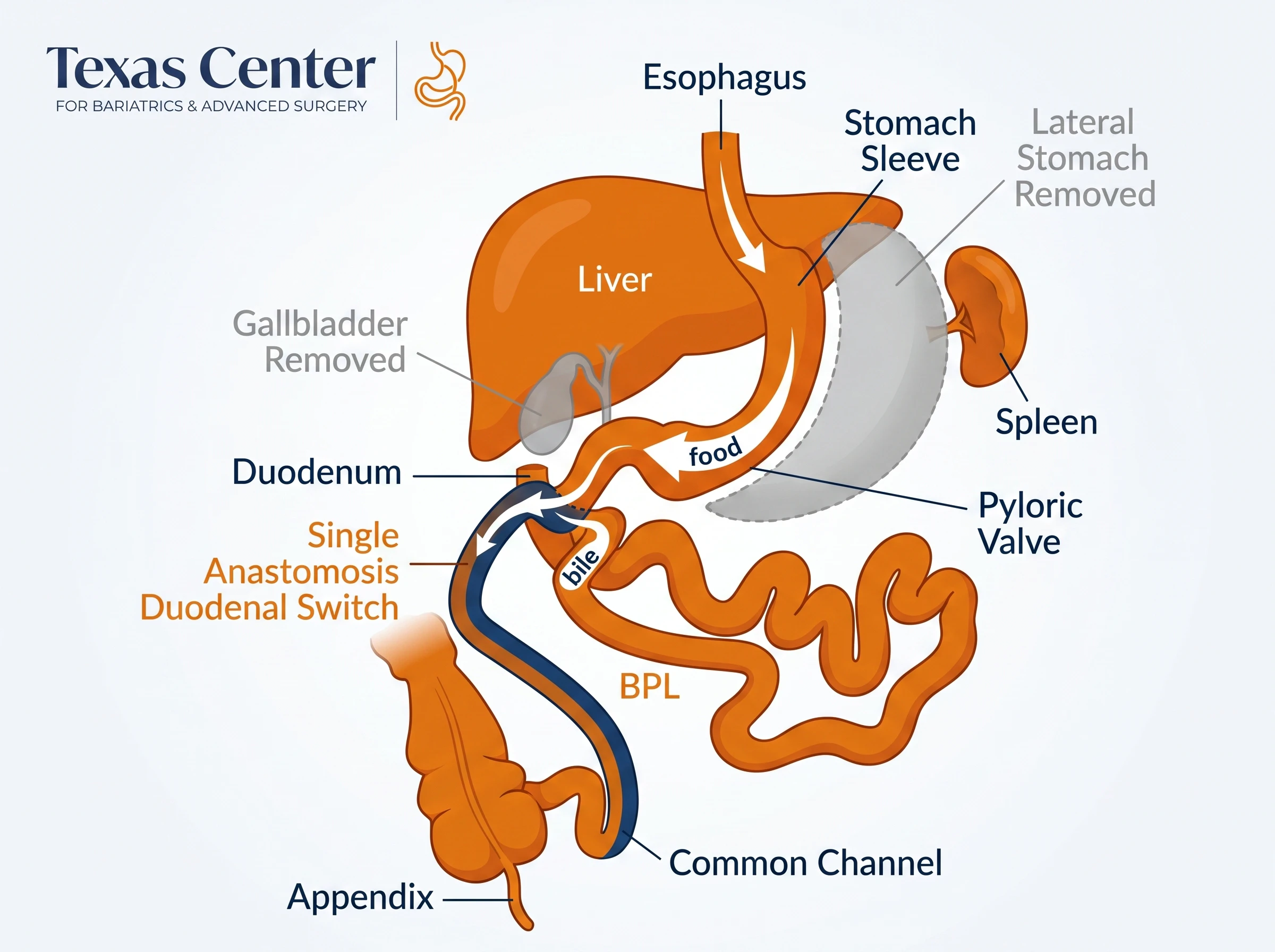 Texas Center for Bariatrics & Advanced Surgery graph of food flowing through the esophagus, stomach sleeve, and pyloric valve. Joining bile, it flows through the single anastomosis duodenal switch in the common channel meeting the appendix. the lateral stomach and gallbladder are removed while the spleen and BPL remains.