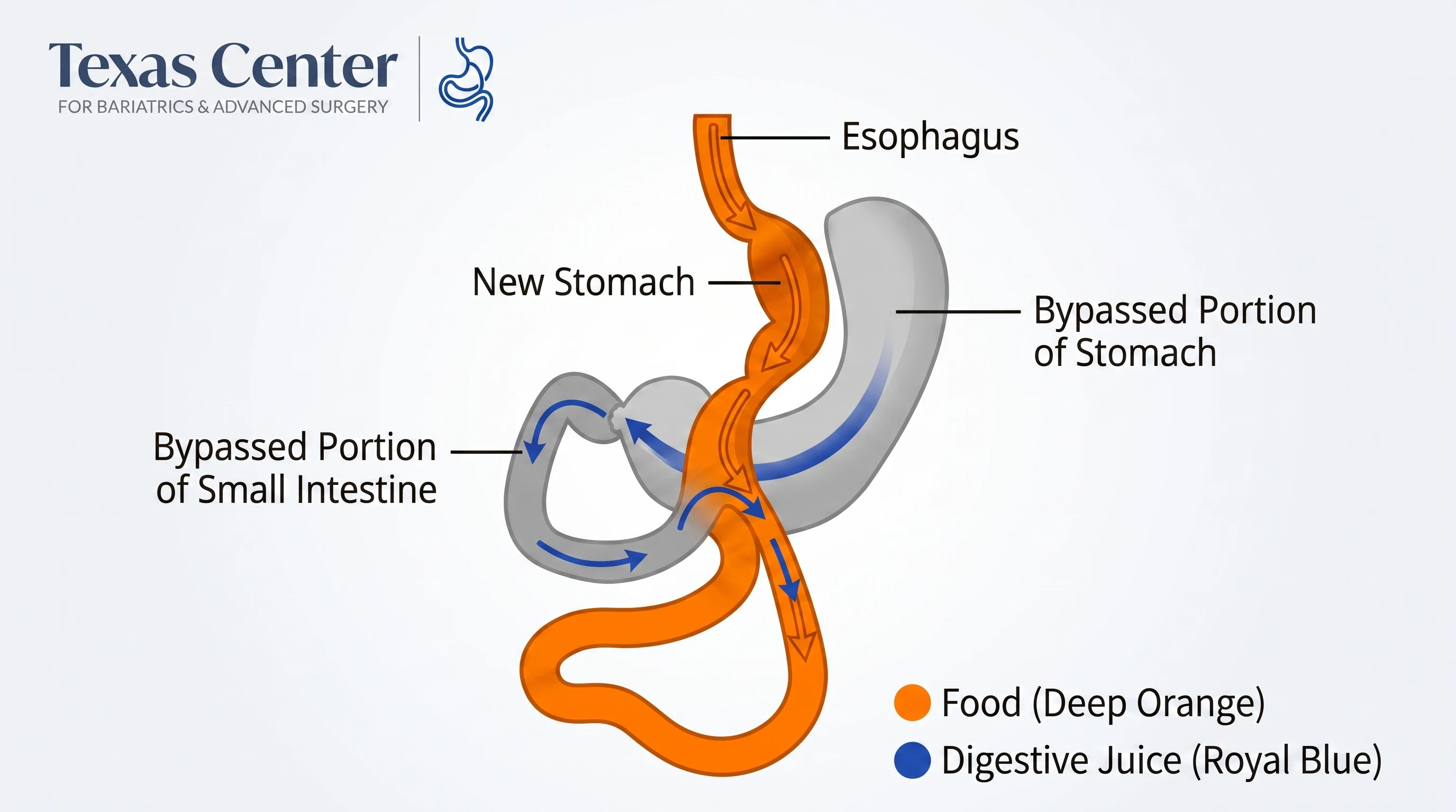 Texas Center for Bariatrics & Advanced Surgery graph of food (deep orange) flowing through the esophagus and then new stomach. the bypassed portion of the stomach has digestive juice (royal blue) flowing through the bypassed portion of small intestine