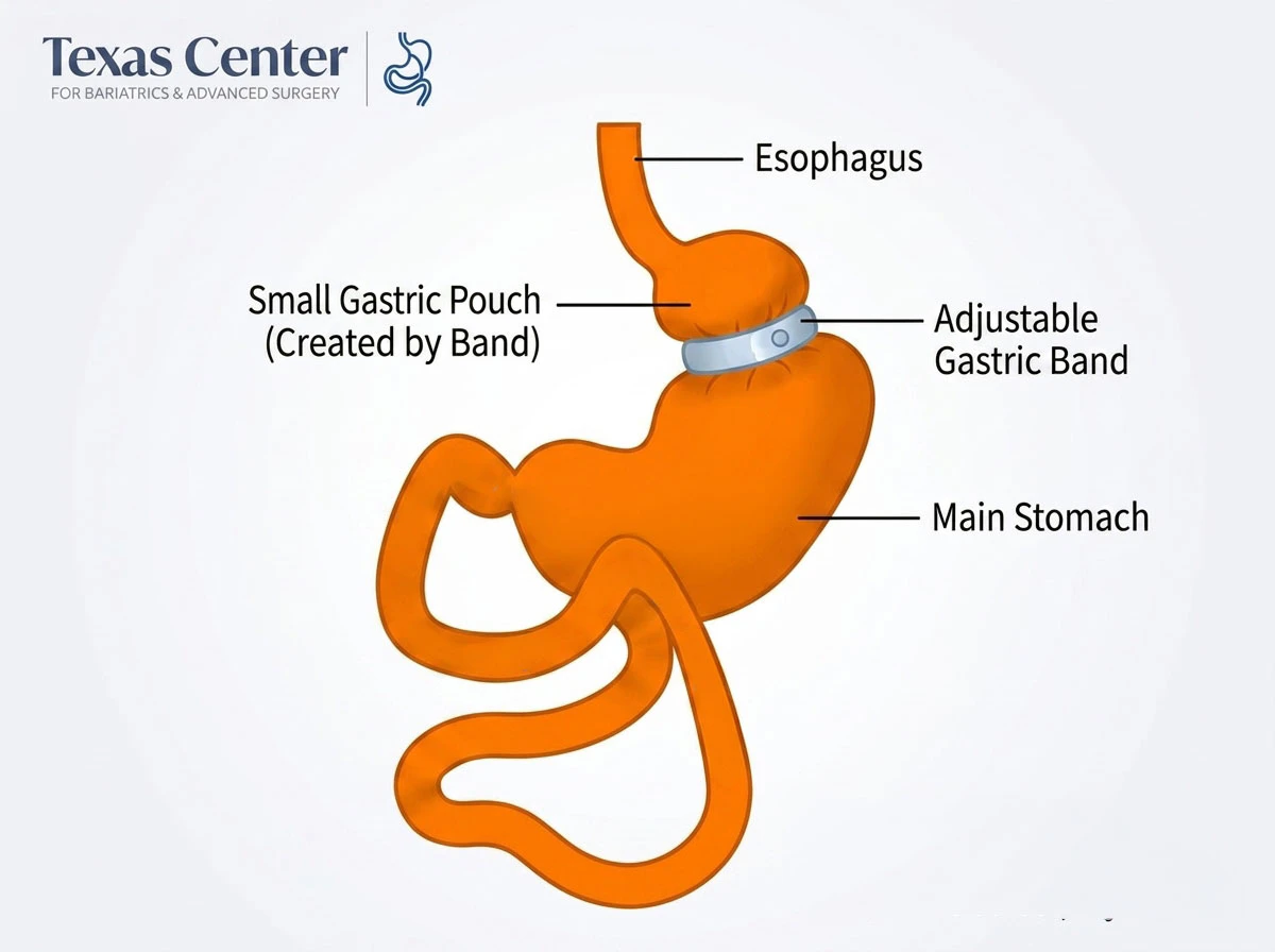 Texas Center diagram of gastric band around stomach