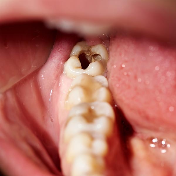 Decaying tooth
