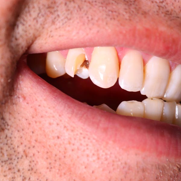 Damaged tooth