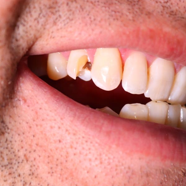 Damaged tooth
