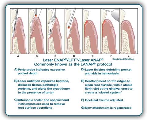 Laser Dentistry Vero Beach, FL - Reiner Family Dental
