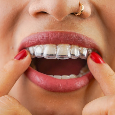 a woman placing an Invisalign appliance on her teeth