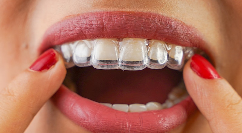 a woman placing an Invisalign appliance on her teeth