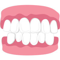 overcrowded teeth