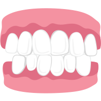 overcrowded teeth