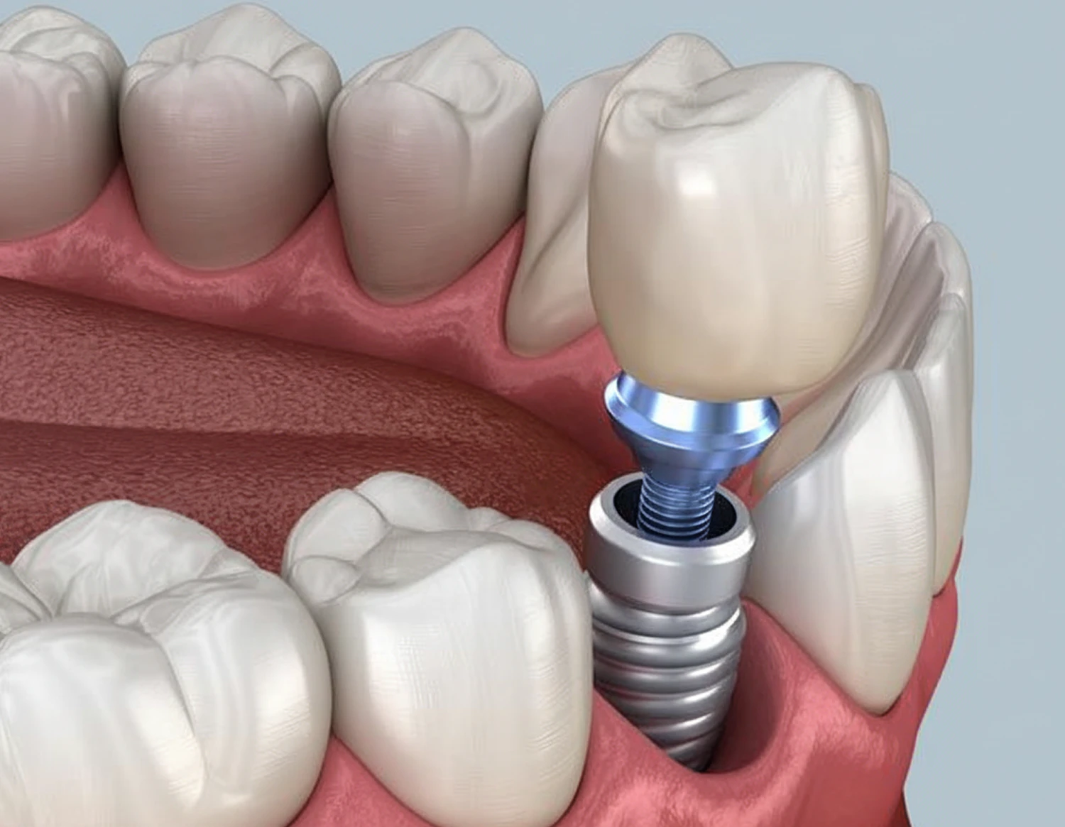 dental implant diagram
