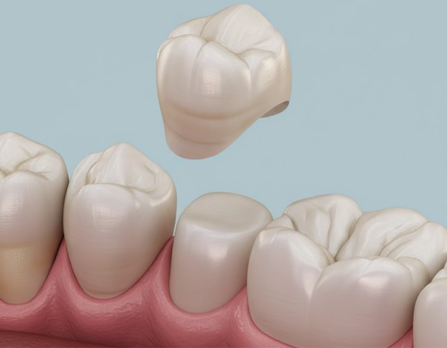 dental crown diagram