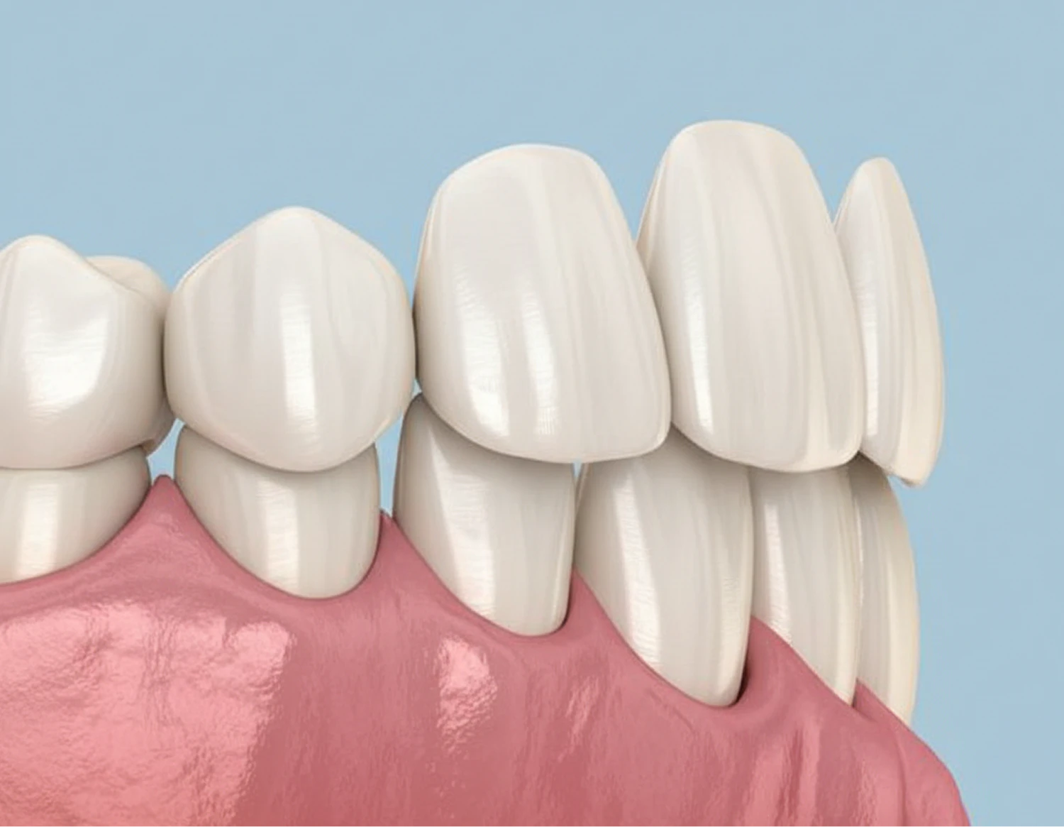 veneers diagram